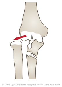 ED_Section 1_BADO FRACTURE TYPE 3.jpg